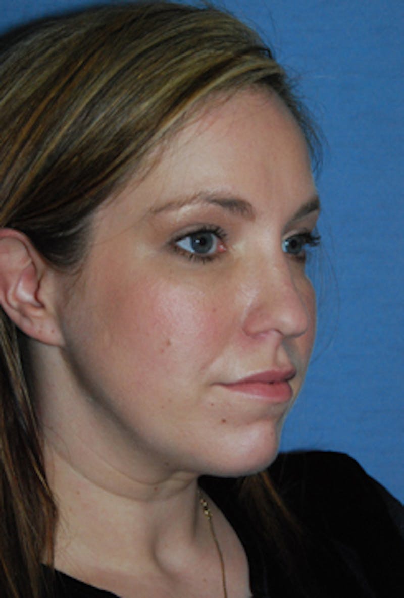 YoungVitalizer Before & After Gallery - Patient 738433 - Image 6
