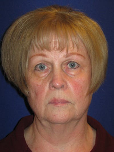 YoungVitalizer Before & After Gallery - Patient 355458 - Image 1