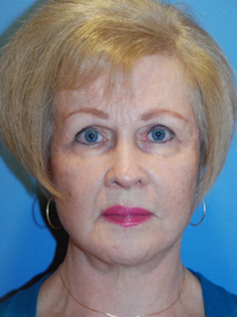YoungVitalizer Before & After Gallery - Patient 355458 - Image 2