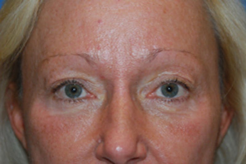 YoungVitalizer Before & After Gallery - Patient 126798 - Image 1