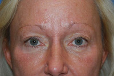 YoungVitalizer Before & After Gallery - Patient 126798 - Image 1