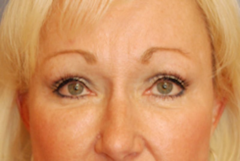 YoungVitalizer Before & After Gallery - Patient 126798 - Image 2