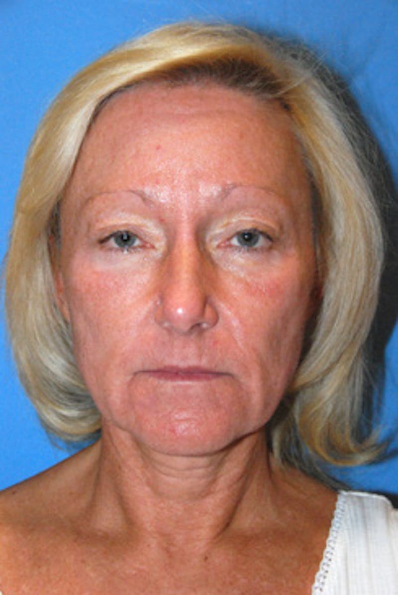 YoungVitalizer Before & After Gallery - Patient 126798 - Image 3