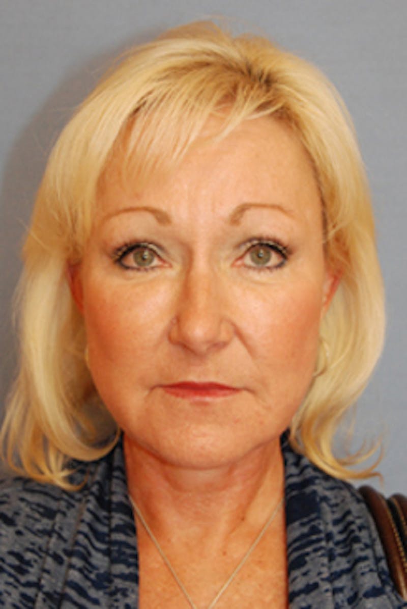 YoungVitalizer Before & After Gallery - Patient 126798 - Image 4