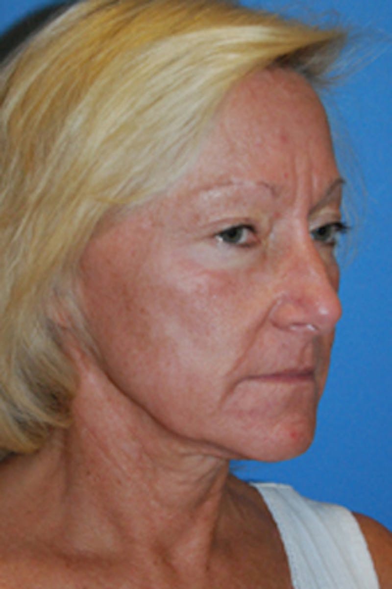 YoungVitalizer Before & After Gallery - Patient 126798 - Image 5