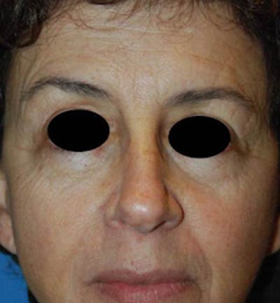 YoungVitalizer Before & After Gallery - Patient 157296 - Image 1