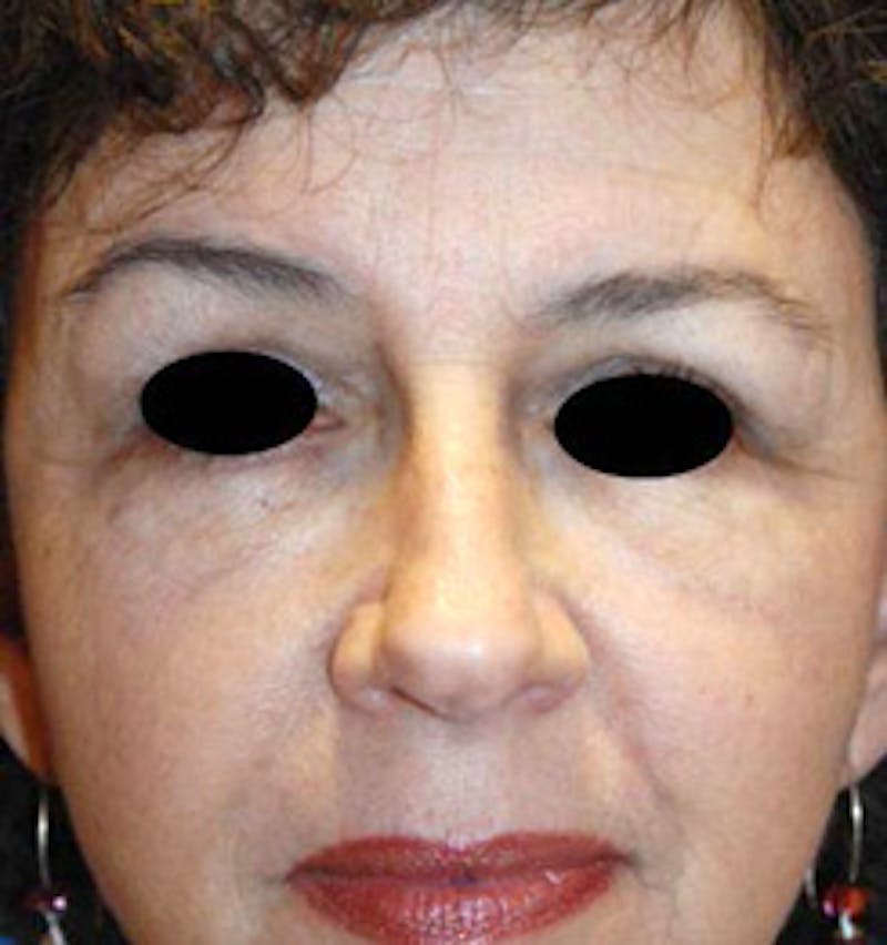 YoungVitalizer Before & After Gallery - Patient 157296 - Image 2