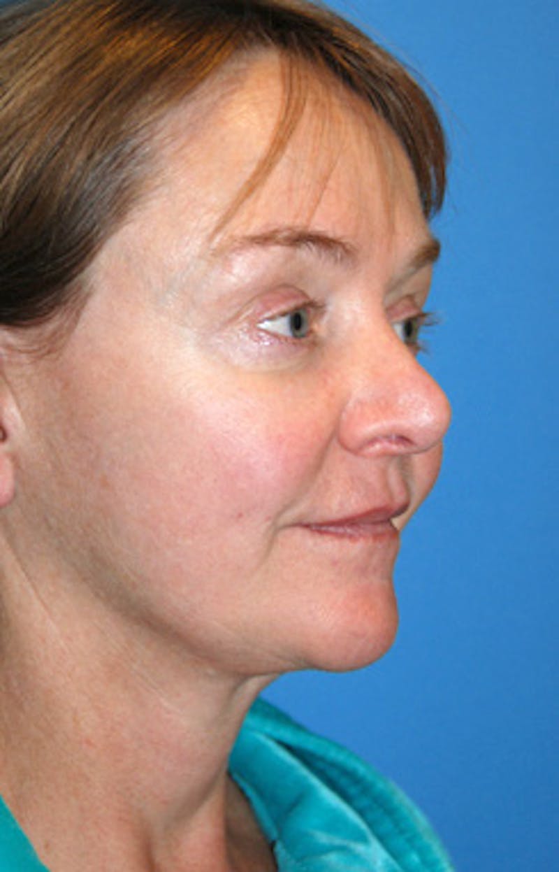 YoungVitalizer Before & After Gallery - Patient 196624 - Image 3
