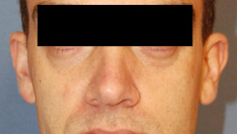 YoungVitalizer Before & After Gallery - Patient 859985 - Image 1