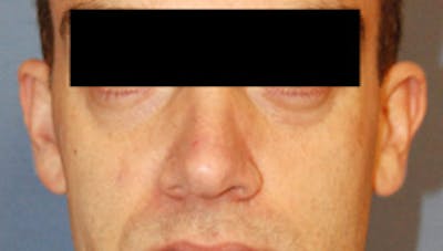 YoungVitalizer Before & After Gallery - Patient 859985 - Image 1