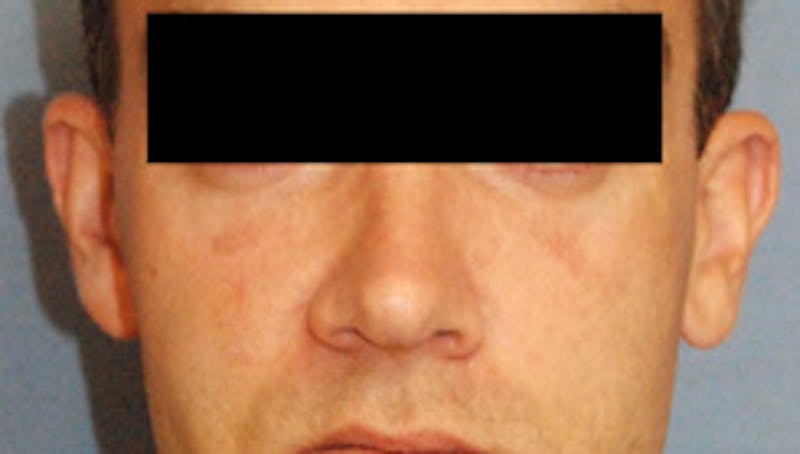 YoungVitalizer Before & After Gallery - Patient 859985 - Image 2