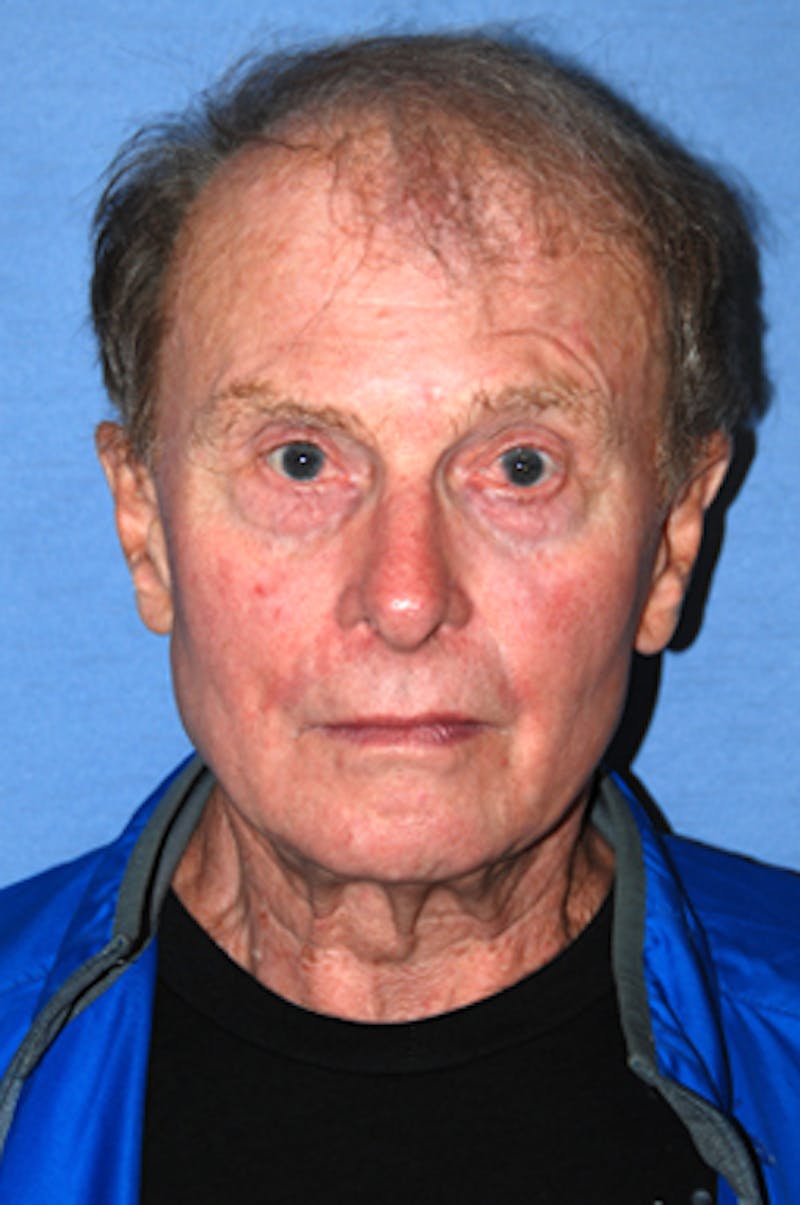 YoungVitalizer Before & After Gallery - Patient 375246 - Image 1