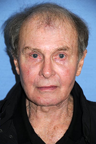 YoungVitalizer Before & After Gallery - Patient 375246 - Image 2