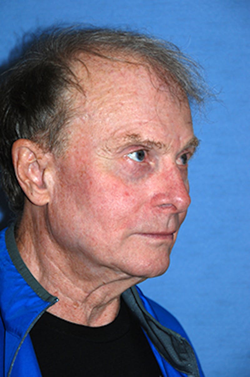 YoungVitalizer Before & After Gallery - Patient 375246 - Image 3