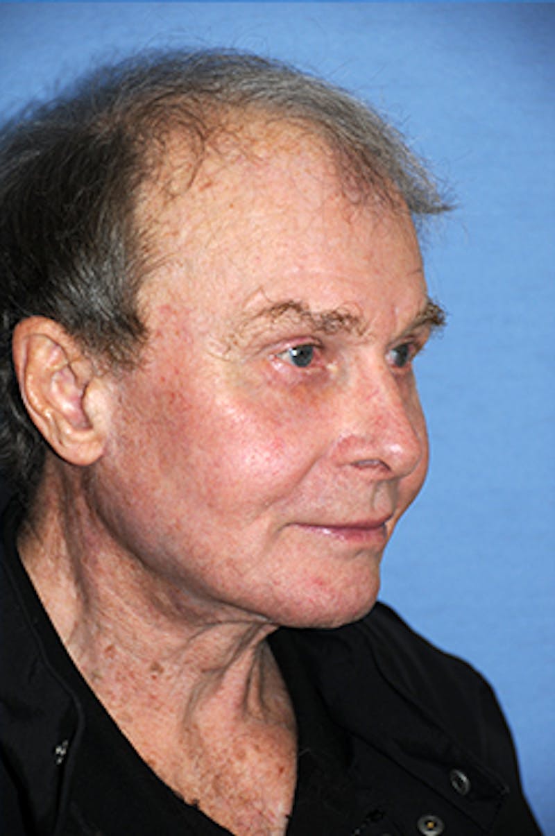 YoungVitalizer Before & After Gallery - Patient 375246 - Image 4