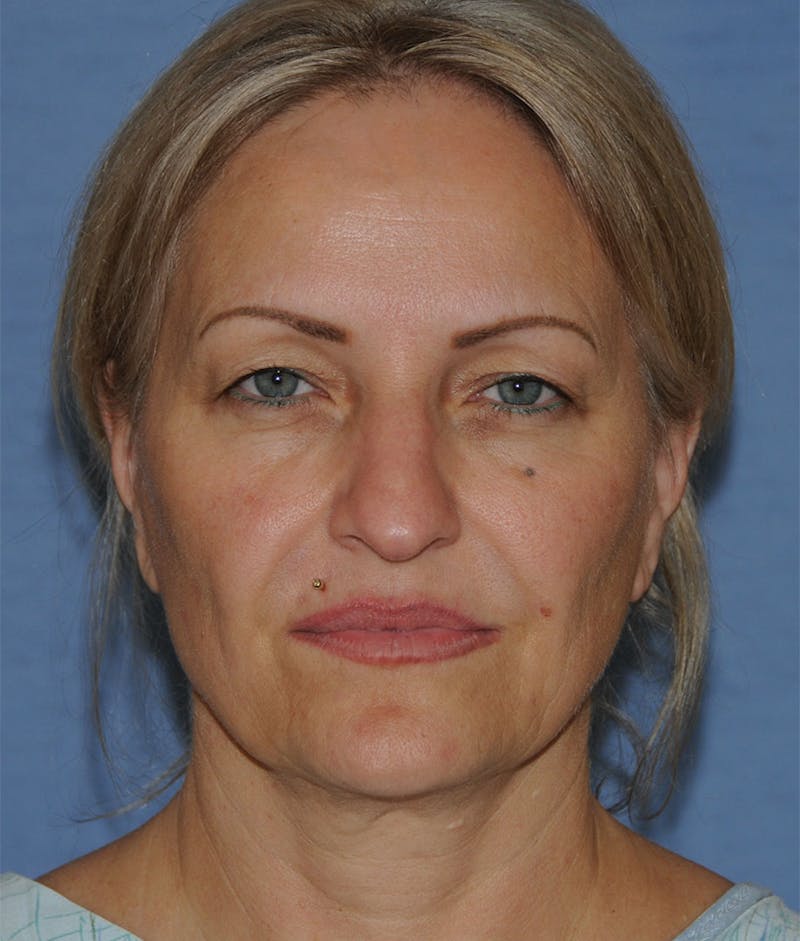 YoungVitalizer Before & After Gallery - Patient 264590 - Image 1