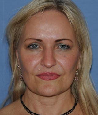 YoungVitalizer Before & After Gallery - Patient 264590 - Image 2
