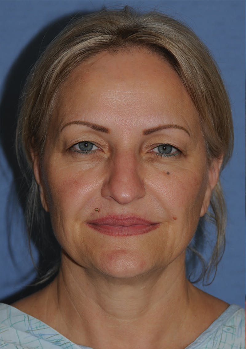 YoungVitalizer Before & After Gallery - Patient 264590 - Image 3