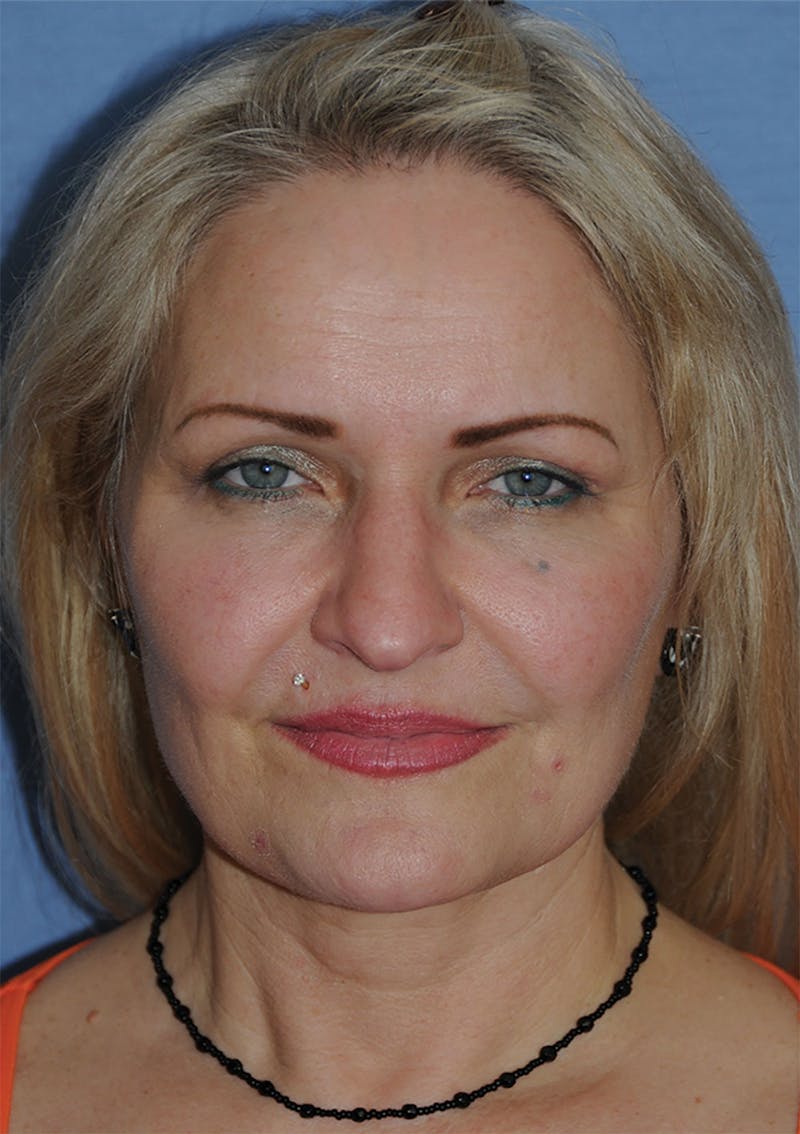 YoungVitalizer Before & After Gallery - Patient 264590 - Image 4