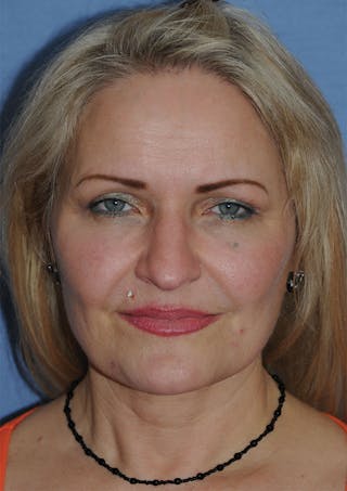 YoungVitalizer Before & After Gallery - Patient 264590 - Image 4