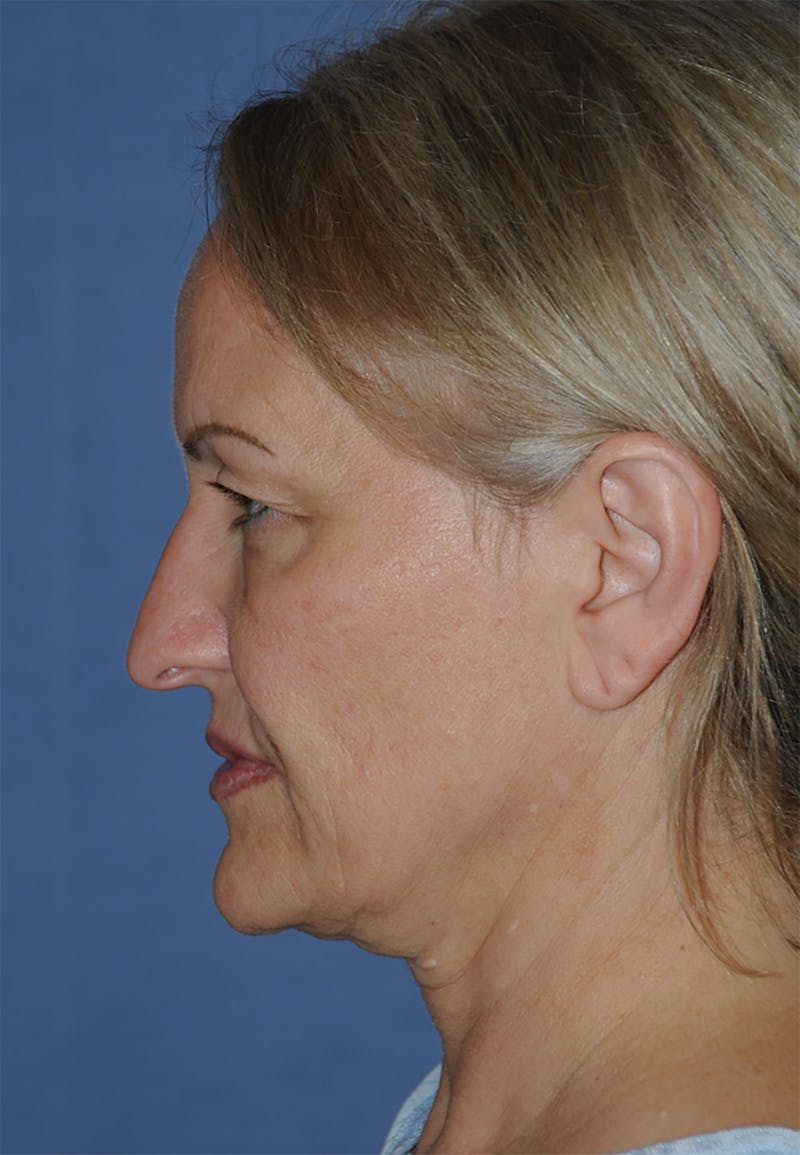 YoungVitalizer Before & After Gallery - Patient 264590 - Image 5