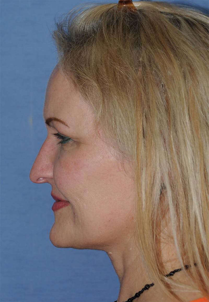 YoungVitalizer Before & After Gallery - Patient 264590 - Image 6