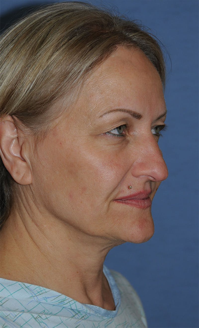 YoungVitalizer Before & After Gallery - Patient 264590 - Image 7