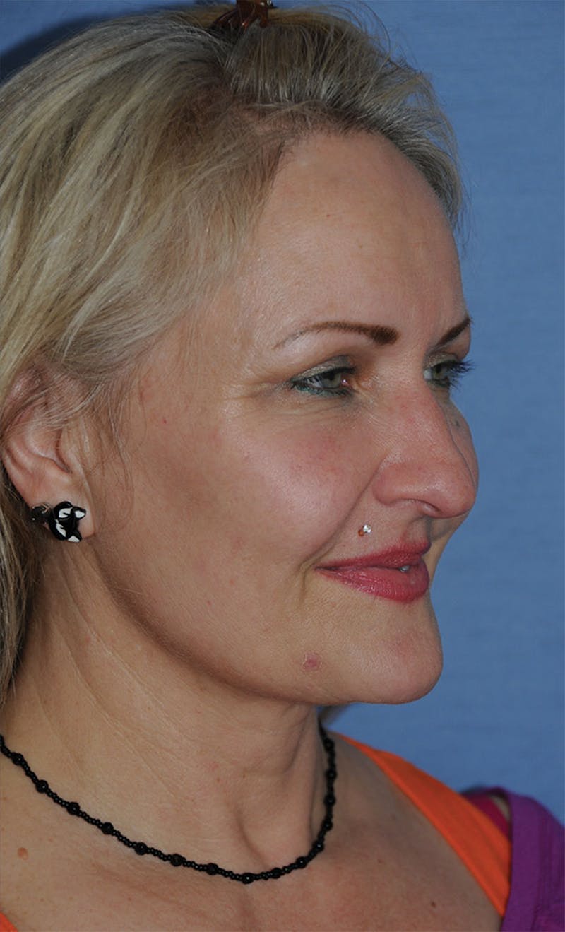 YoungVitalizer Before & After Gallery - Patient 264590 - Image 8