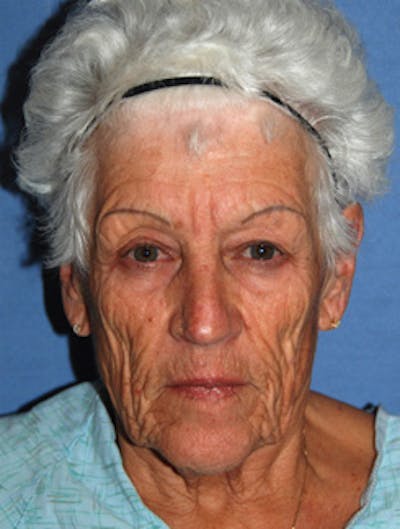 YoungVitalizer Before & After Gallery - Patient 399984 - Image 1