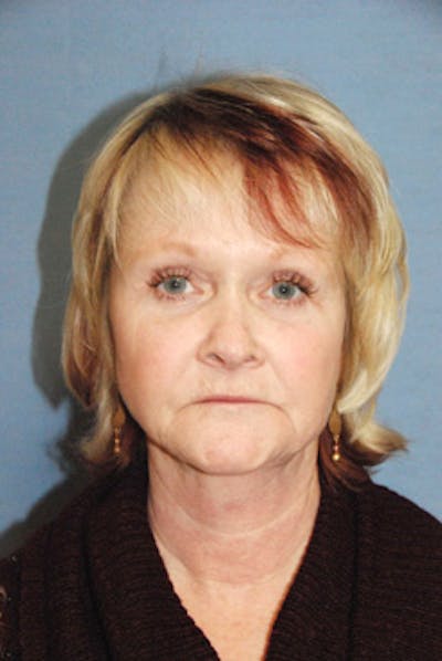 YoungVitalizer Before & After Gallery - Patient 673805 - Image 2