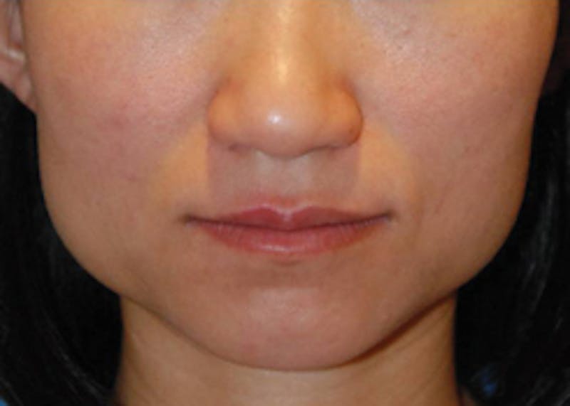 Botox® Dysport Before & After Gallery - Patient 159691 - Image 1