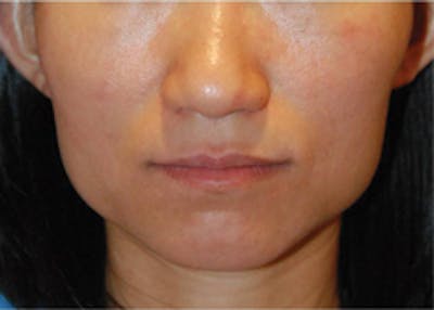 Botox® Dysport Before & After Gallery - Patient 159691 - Image 2