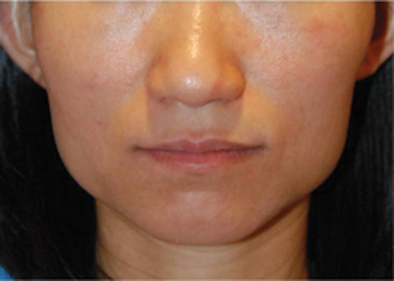 Botox® Dysport Before & After Gallery - Patient 159691 - Image 2