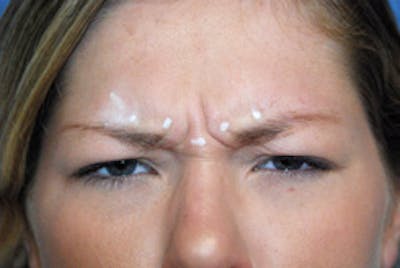 Botox® Dysport Before & After Gallery - Patient 299076 - Image 1