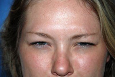 Botox® Dysport Before & After Gallery - Patient 299076 - Image 2