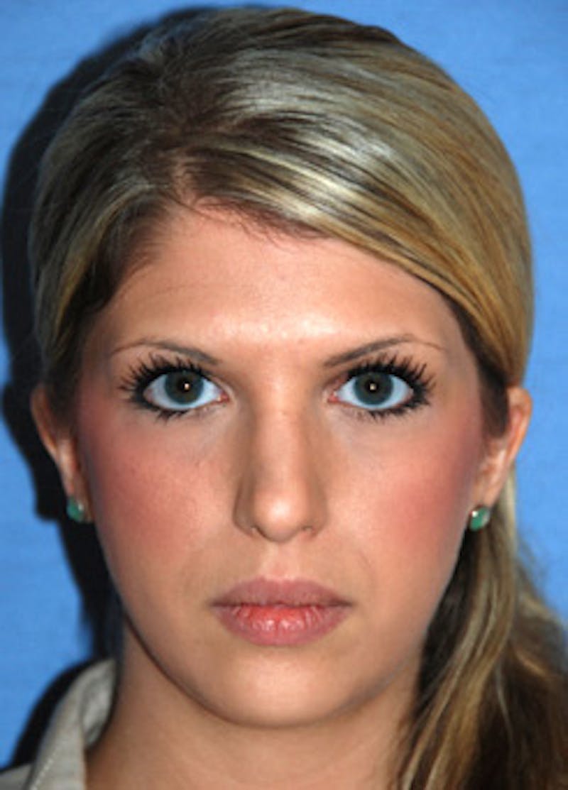 Botox® Dysport Before & After Gallery - Patient 102060 - Image 1