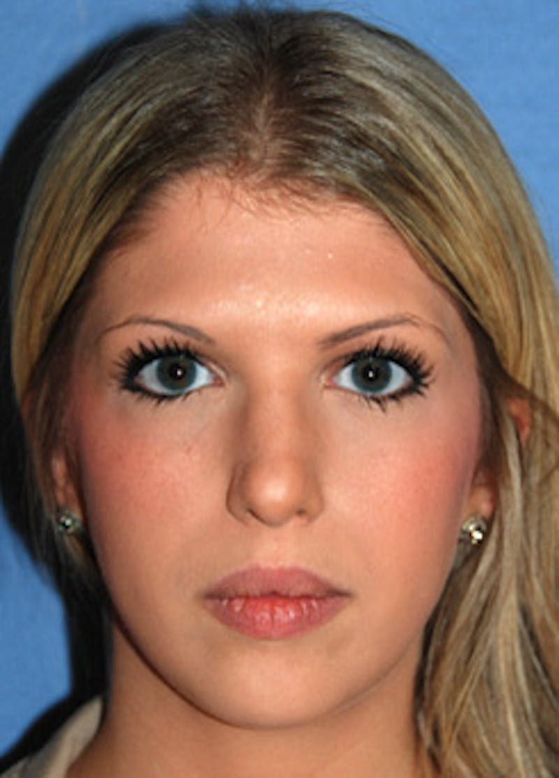 Botox® Dysport Before & After Gallery - Patient 102060 - Image 2