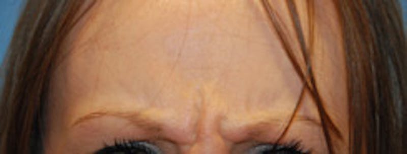 Botox® Dysport Before & After Gallery - Patient 183569 - Image 1