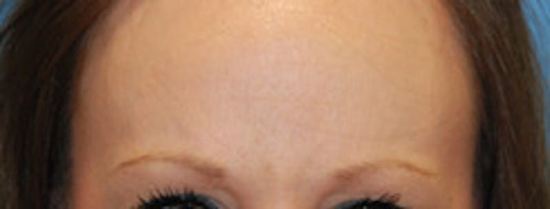 Botox® Dysport Before & After Gallery - Patient 183569 - Image 2