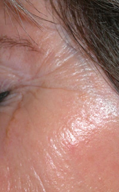 Chemical Peel Before & After Gallery - Patient 218216 - Image 1