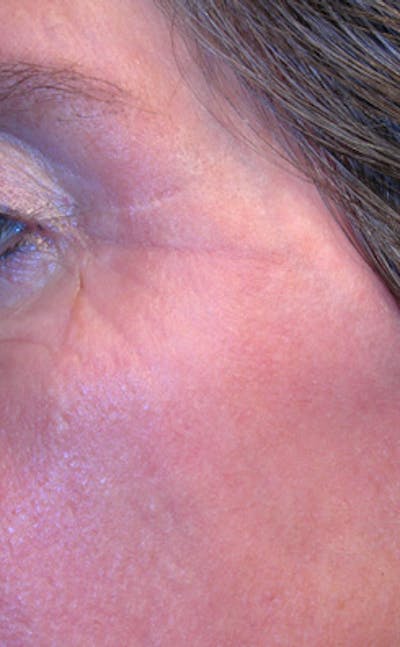 Chemical Peel Before & After Gallery - Patient 218216 - Image 2
