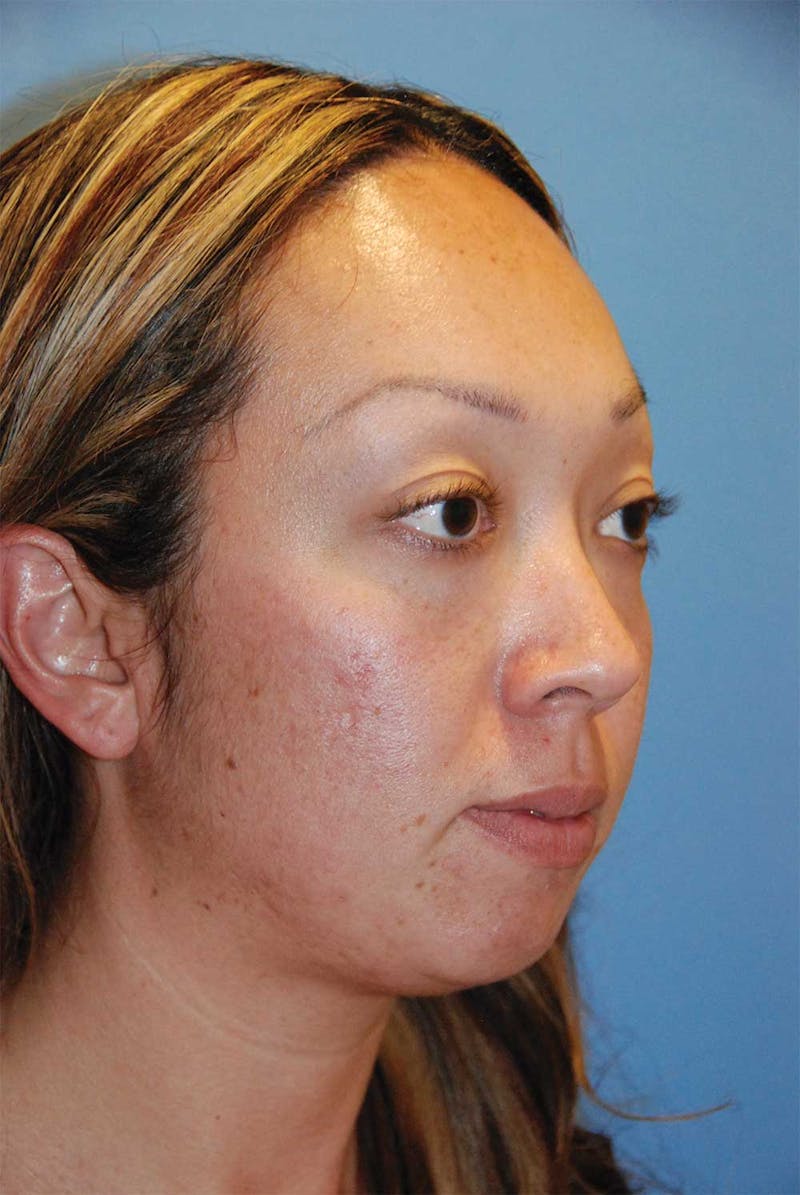 Facial Fillers / Injectables Before & After Gallery - Patient 305680 - Image 5
