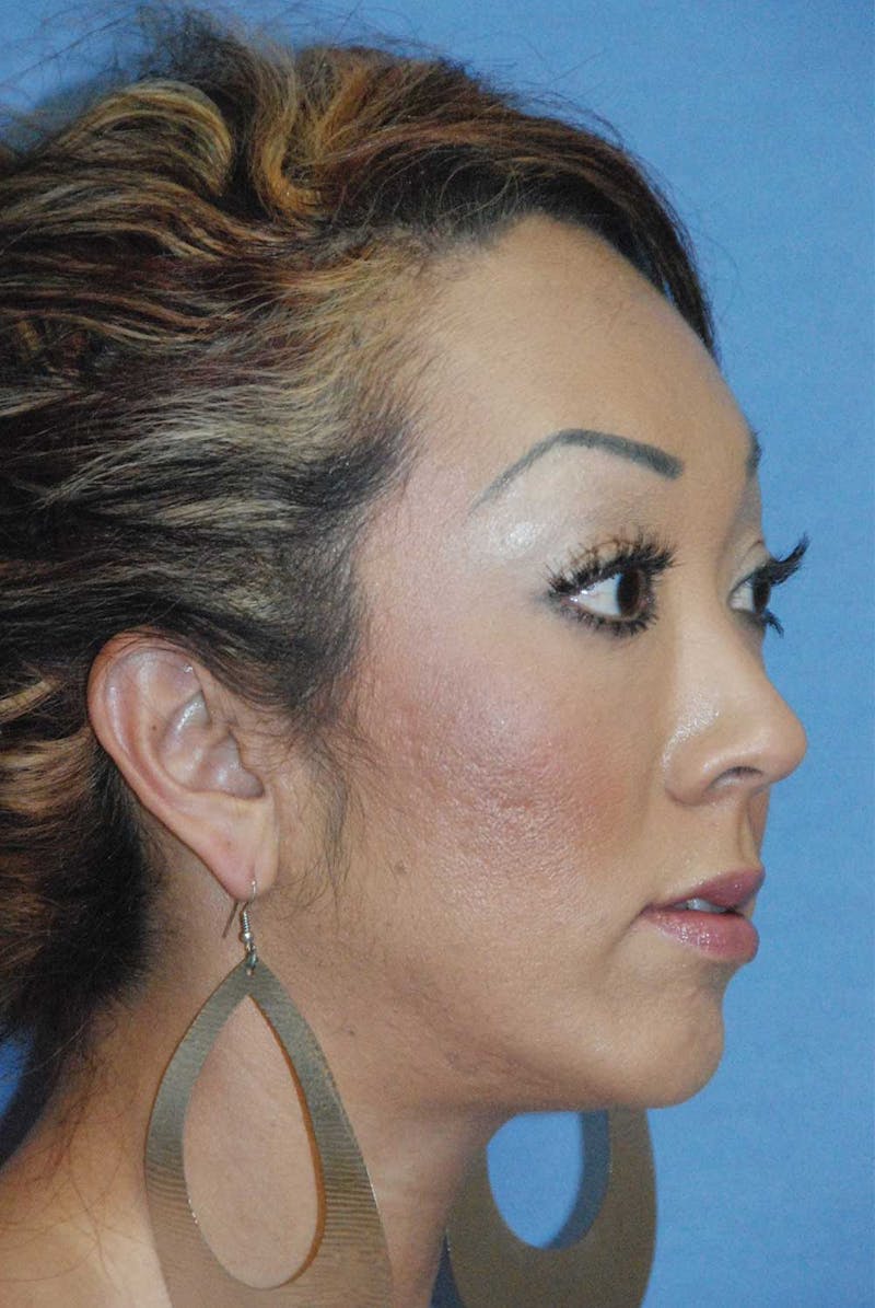 Facial Fillers / Injectables Before & After Gallery - Patient 305680 - Image 6