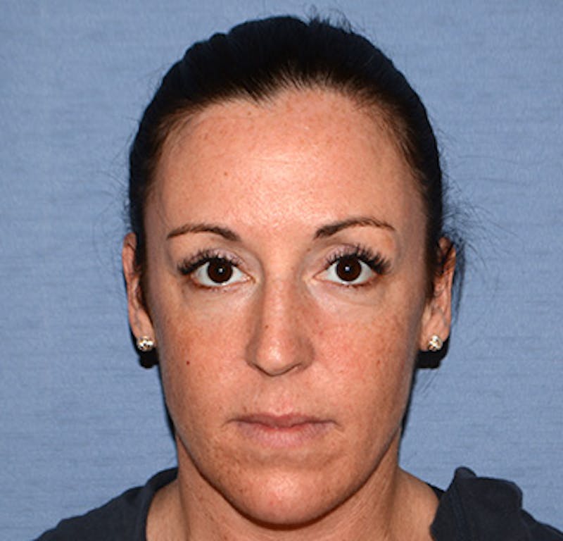 Facial Fillers / Injectables Before & After Gallery - Patient 222059 - Image 1