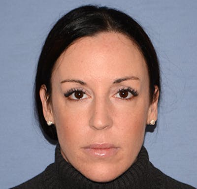 Facial Fillers / Injectables Before & After Gallery - Patient 222059 - Image 2