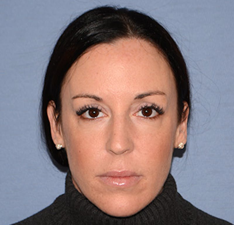 Facial Fillers / Injectables Before & After Gallery - Patient 222059 - Image 2