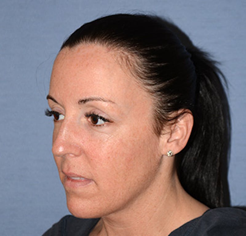 Facial Fillers / Injectables Before & After Gallery - Patient 222059 - Image 3