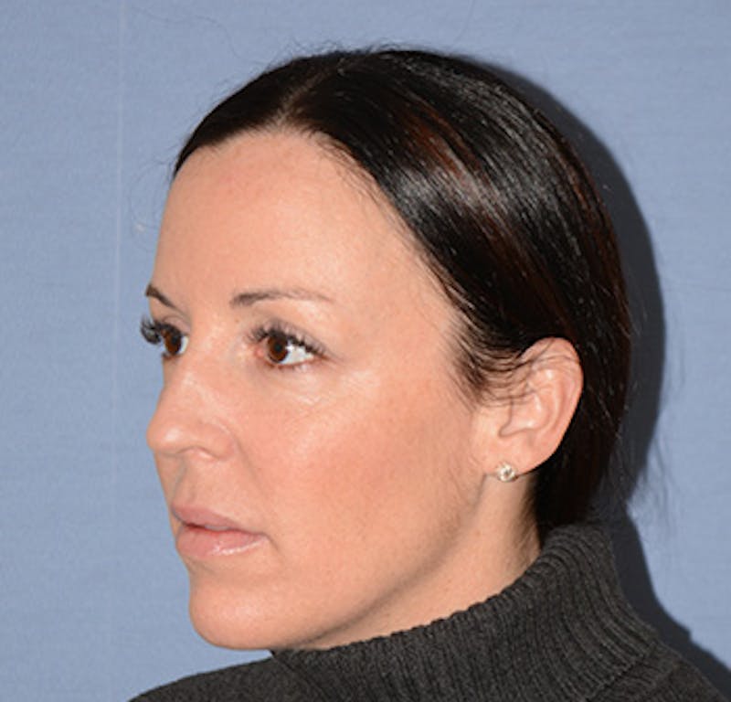 Facial Fillers / Injectables Before & After Gallery - Patient 222059 - Image 4