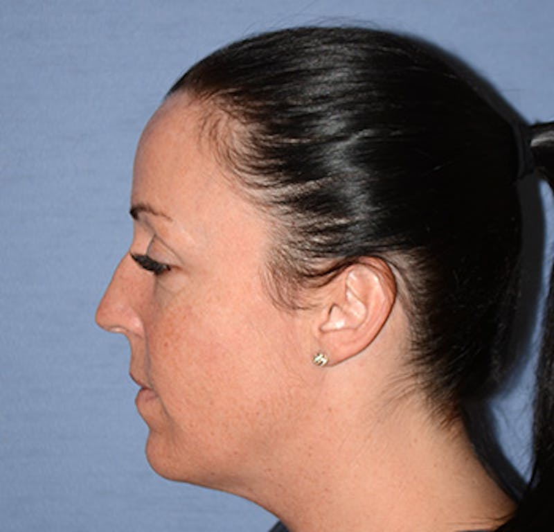 Facial Fillers / Injectables Before & After Gallery - Patient 222059 - Image 5