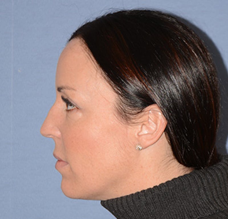Facial Fillers / Injectables Before & After Gallery - Patient 222059 - Image 6